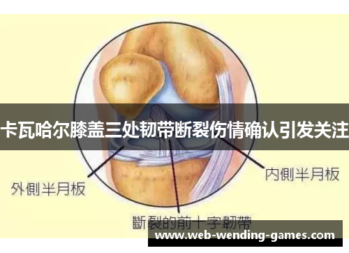 卡瓦哈尔膝盖三处韧带断裂伤情确认引发关注